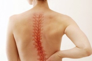 Упражнения для спины при заболевании сколиозом или его профилактике